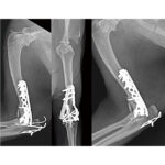 2.7mm Cuttable Malleable Plate - Image 2
