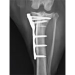 ALPS Il TPLO Titanium Plates - Image 6