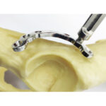 Acetabular Locking Plates - Image 2