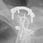 Acetabular Plates - Image 2