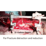 Distraction And Reduction Tool Set - Image 4