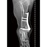 Double T Cuttable Locking Plates - Image 4