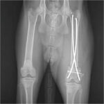 Elastic Nail - Image 3