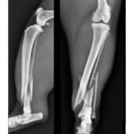 Lengthening Locking Plates - Image 2
