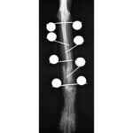 Mini External Fixation System - Image 2