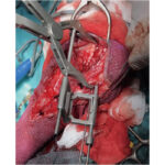 Pointed Reduction Forceps With Aiming Device - Image 2