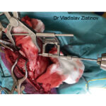 Pointed Reduction Forceps With Aiming Device - Image 3