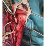 Pointed Reduction Forceps With Aiming Device - Image 4