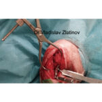 Pointed Redyction Forceps With Spinlock - Image 2