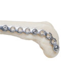 Reconstruction Type Bending Irons (Pair) - Image 7