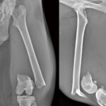 Supracondylar Plates - Image 2