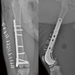 Supracondylar Plates - Image 3
